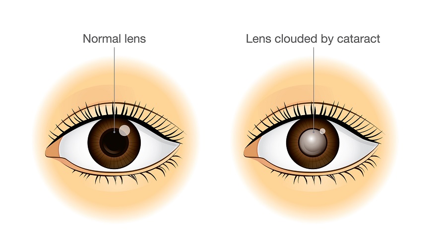 How to Prevent Cataracts