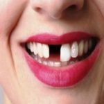 8 Common Causes Of Missing Teeth In Adults