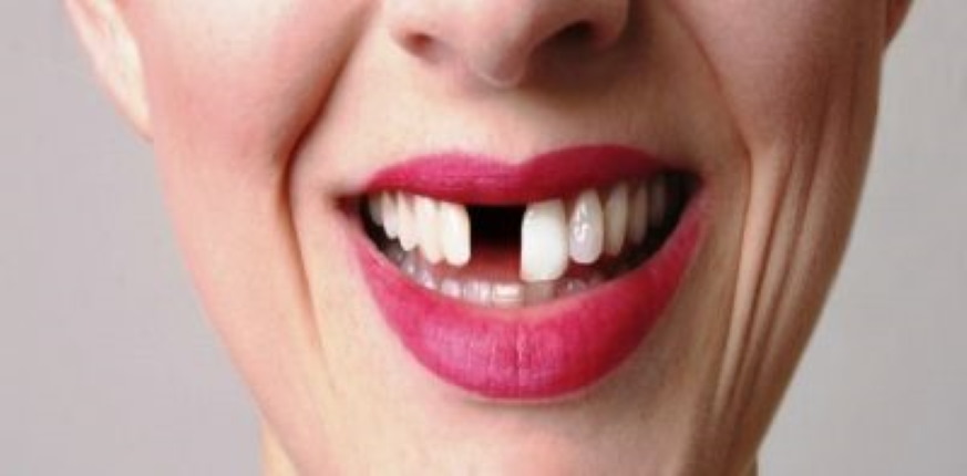 8 Common Causes Of Missing Teeth In Adults