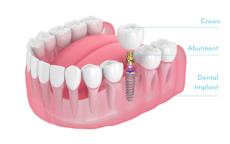 5 Key Facts About Dental Implants You Should Know